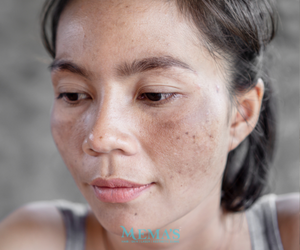 Clear Skin with Melasma Treatment at Memas Clinic.