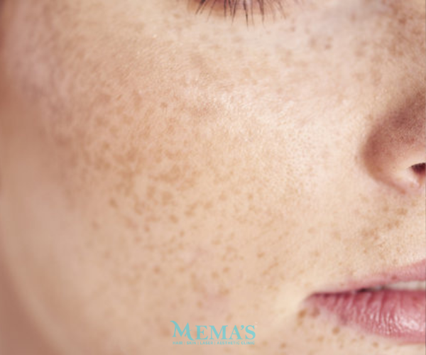 Fade Freckles with Expert Care at Memas Clinic.