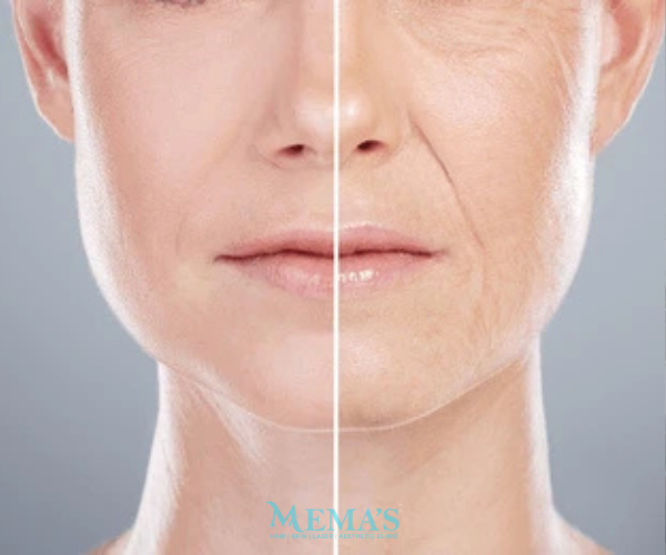 Turn Back Time with Anti-Aging at Memas Clinic.