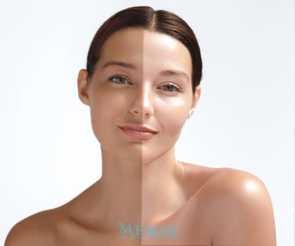 Brighten Your Skin Tone with Whitening at Memas Clinic.