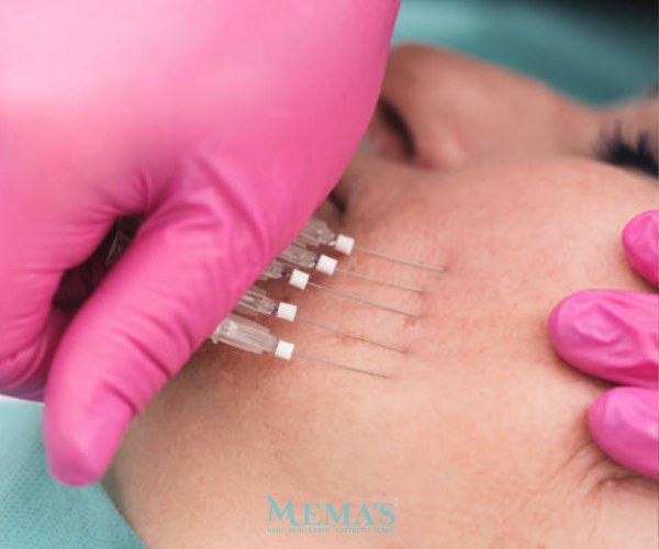 Lift Naturally with Threads at Memas Clinic.