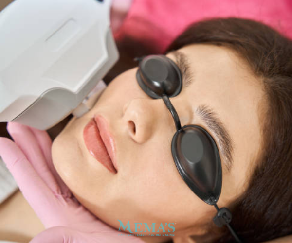 Light Up Your Skin with Photofacial at Memas Clinic.