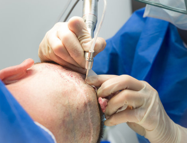 DHT Hair Transplant at Memas Clinic