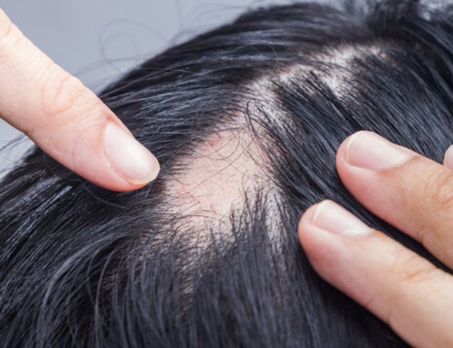Alopecia Treatment at Memas Clinic