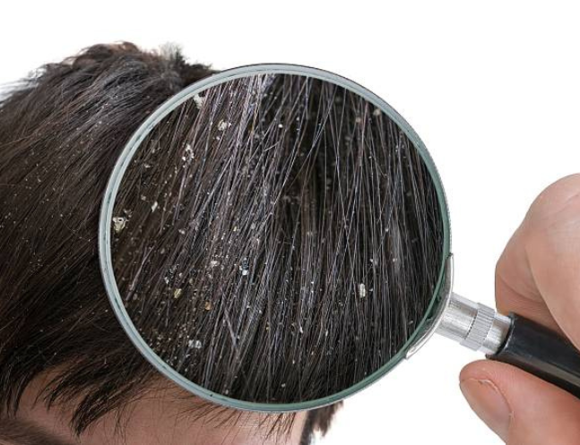 Anti-Dandruff Treatment at Memas Clinic