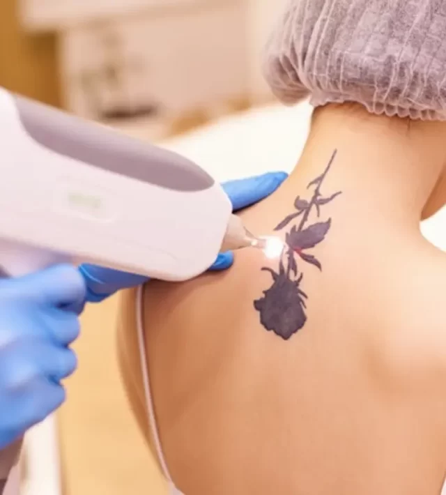 tatto removal in Jaipur