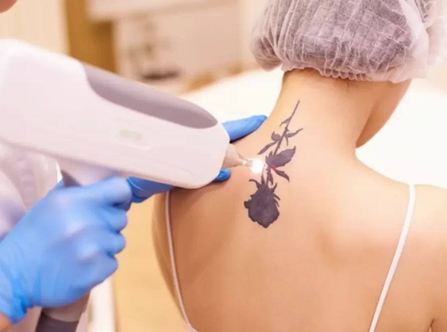 tatto removal in Jaipur