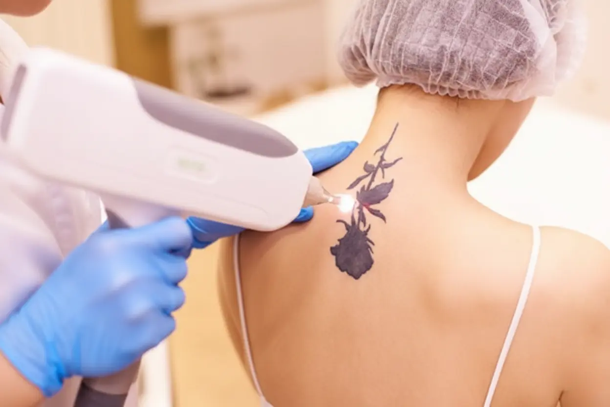 tatto removal in Jaipur
