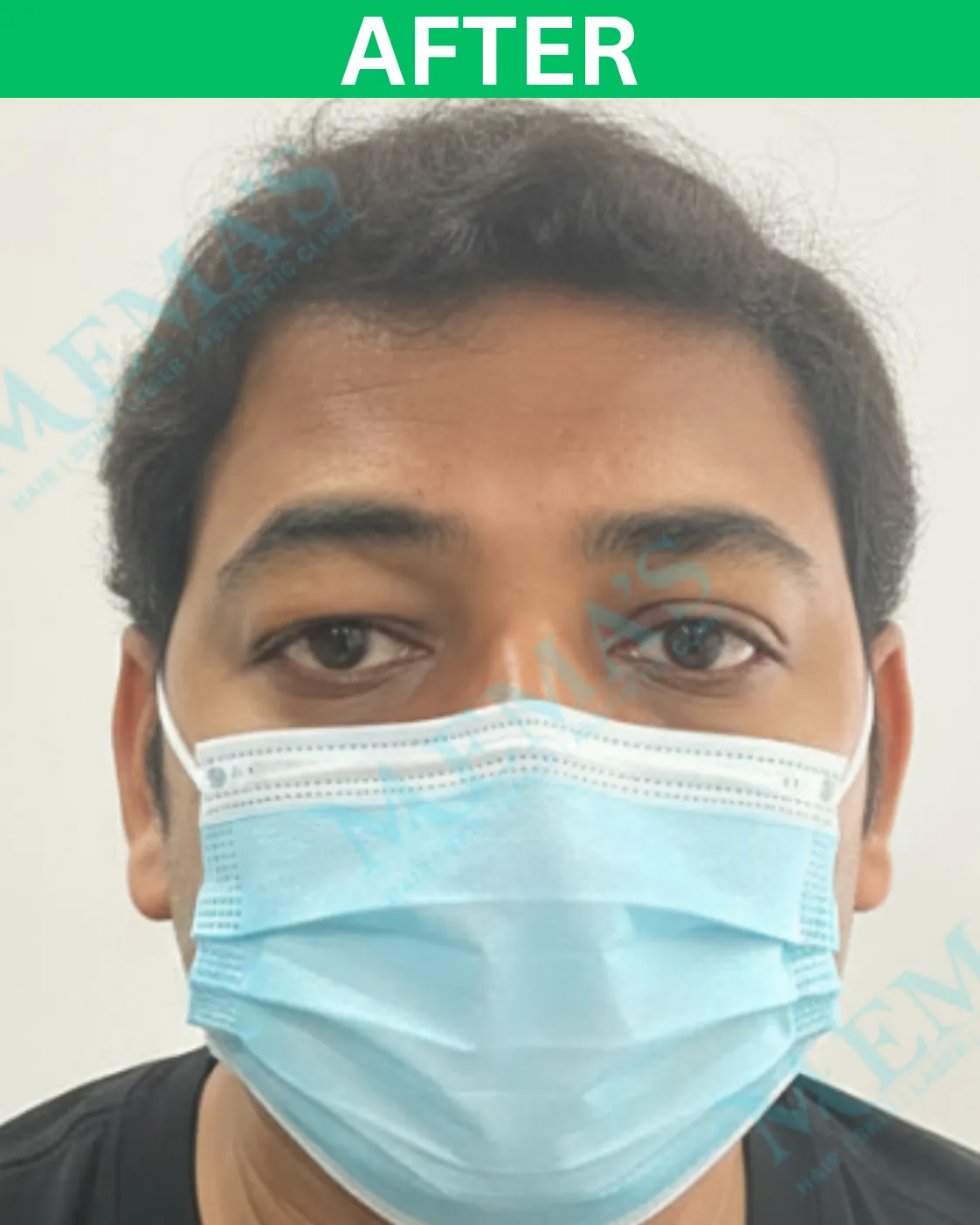 Hair treatment patient result