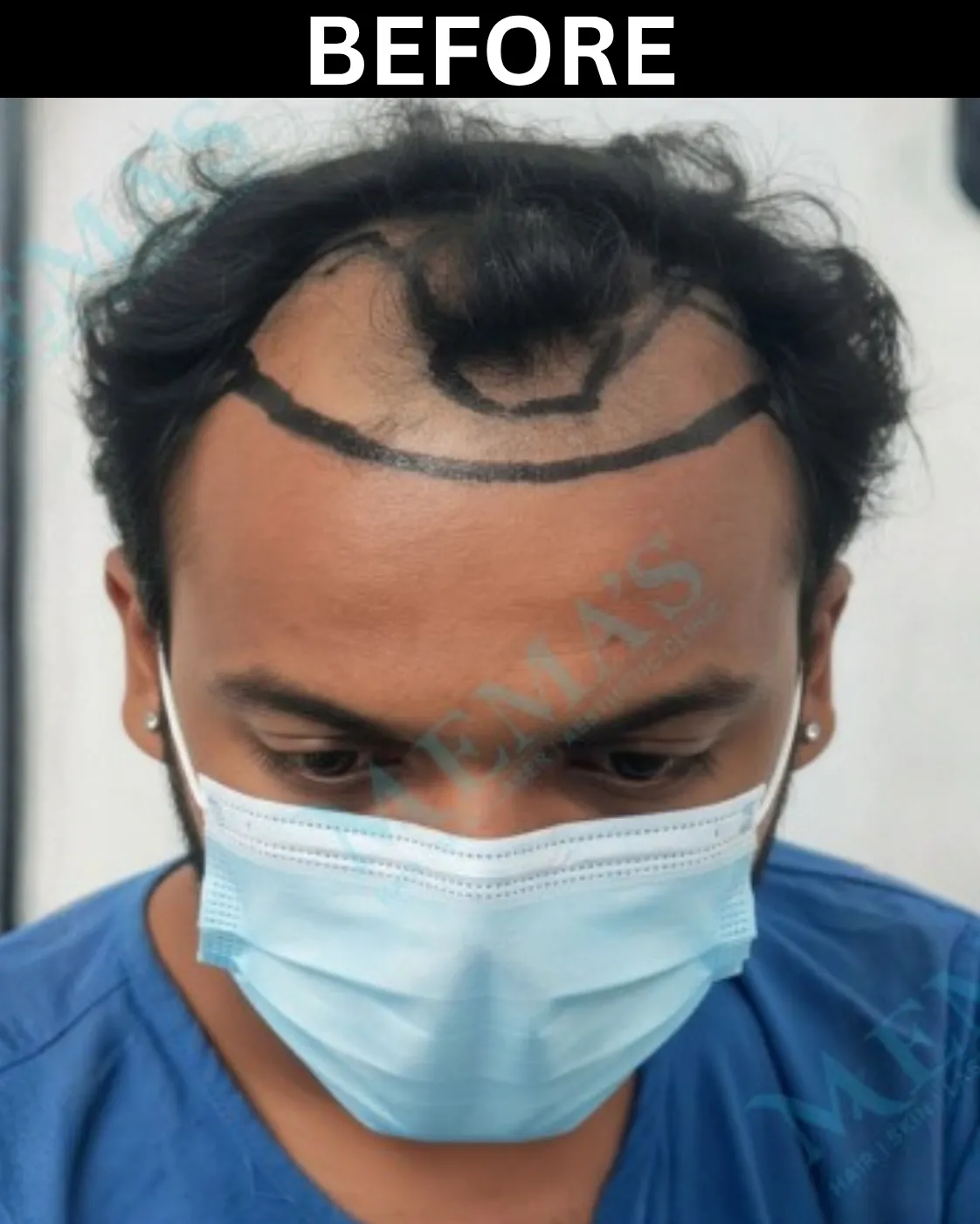 Hair treatment patient result