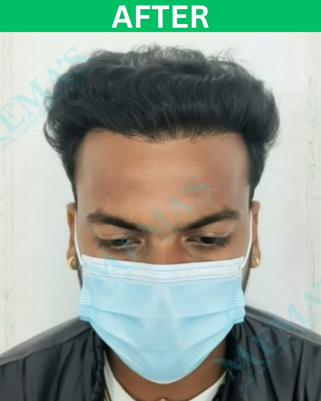 Hair treatment patient result