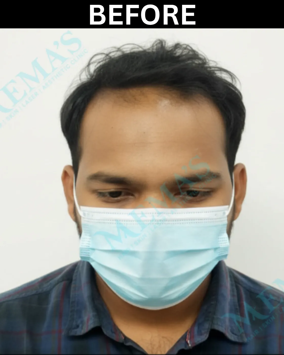 Hair treatment patient result