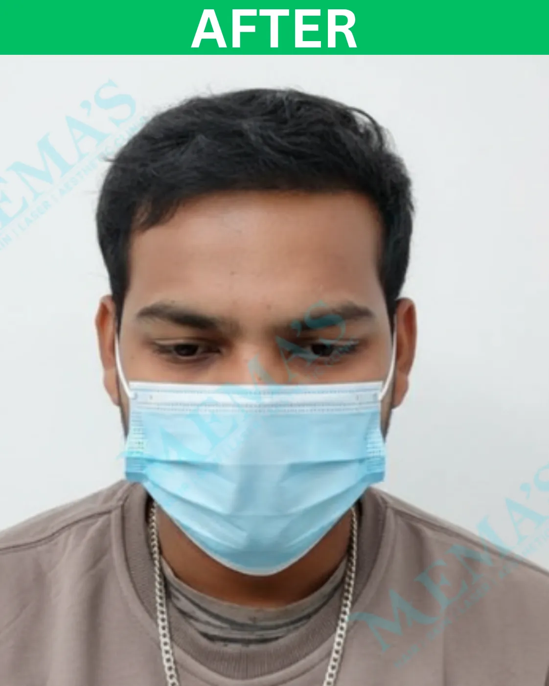 Hair treatment patient result