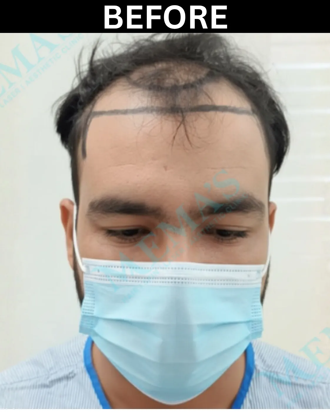 Hair treatment patient result