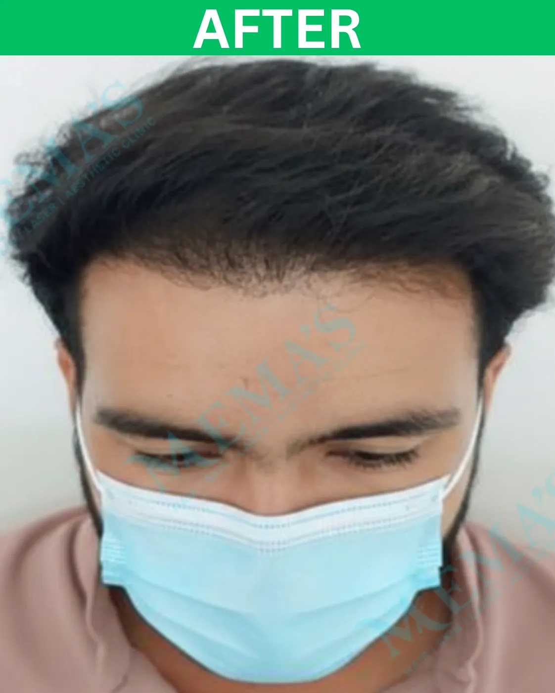 Hair treatment patient result